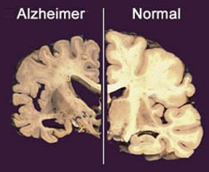 Alzheimer66