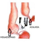 Gli scienziati scoprono che l’acalasia è di origine autoimmune acalasia