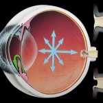 Glaucoma-grphc