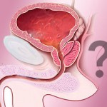 Prostate-Cancer-Screening