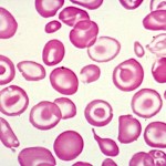 beta-talassemia