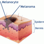 melanoma
