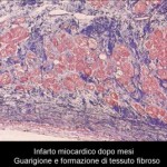 Infarto - Istologia - Dopo mesi