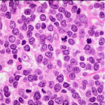 Leucemia