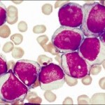 Leucemia-mieloide-acuta-ricerca
