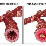 asthma2