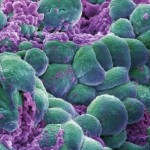 B0006421 Breast cancer cells