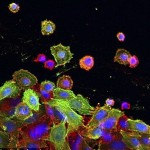 cellule_cancro_colon