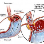 gerd (1)