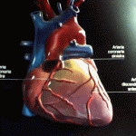 infarto