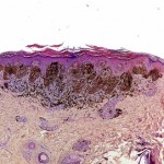 melanoma