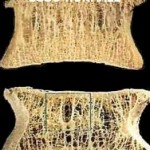 osteoporosi1