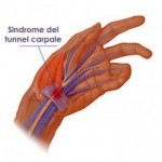 sindrome-del-tunnel-carpale1-300x290