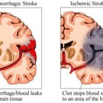 stroke_hem_isc