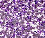 190px-Diffuse_large_B_cell_lymphoma_-_cytology_low_mag