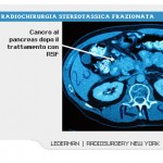 cancro_al_pancreas_6
