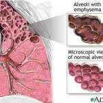 enfisema