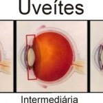 uveite tipos
