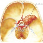 mannino.marco_meningioma-01