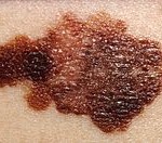 190px-Melanoma