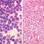 AcuteMyelogenousfig_large1
