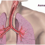 asma