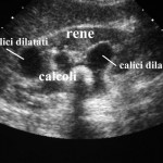 ecografia calcoli renali