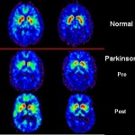 parkinson (1)