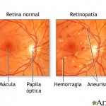 retinopatia diabetica