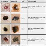 Melanoma (1)