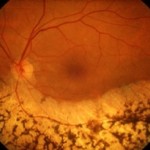 Retinite-pigmentosa2-e1298542984420