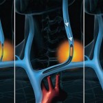 Sclerosi-multipla-e-il-metodo-Zamboni-e-se-bastasse-riaprire-una-vena_h_partb