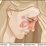 Sinusite-i-sintomi-le-cure-giuste-e-i-nuovi-interventi-senza-dolore