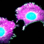 cellule_tumorali_cancro_seno-300x204