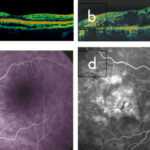retinopatia_diabetica_04