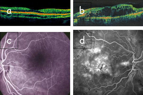 retinopatia_diabetica_04