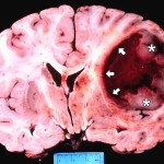 Glioblastoma-Multiforme-Brain-Tumor-Vaccine