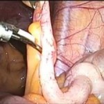 appendicite-acuta-300x225