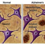 placas-y-neuronas