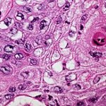 250px-Well_differentiated_squamous_cell_carcinoma
