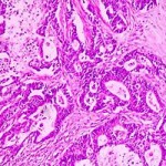 Adenocarcinoma_coli