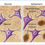 alzheimer (1)
