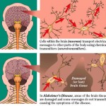 alzheimers-disease