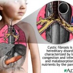 fibrosi_cistica