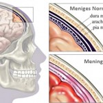 meningite-tratamento-prevencao