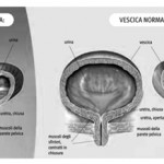 vescica-iperattiva.asp201imhp1