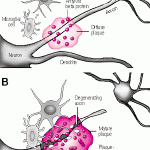 alzheimer (3)
