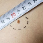 melanoma with hairs on Caucasian man skin with meter