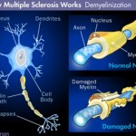 sclerosi_multipla (1)