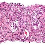 250px-Prostate_cancer_with_Gleason_pattern_4_low_mag
